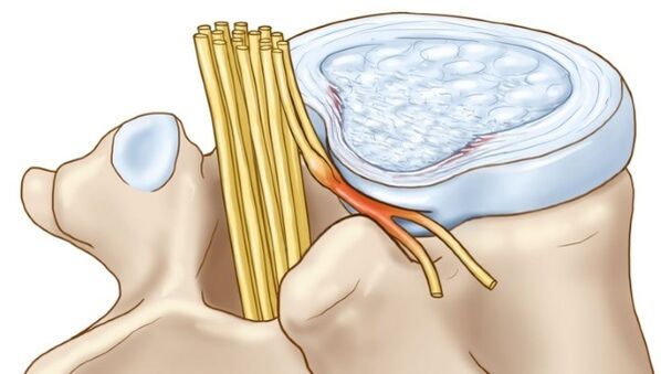 Intervertebral disc protrusions that occur in thoracic osteochondrosis compress nerve endings