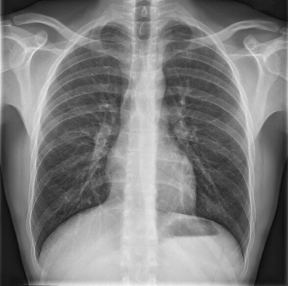 Osteochondrosis of the thoracic spine is diagnosed by radiography