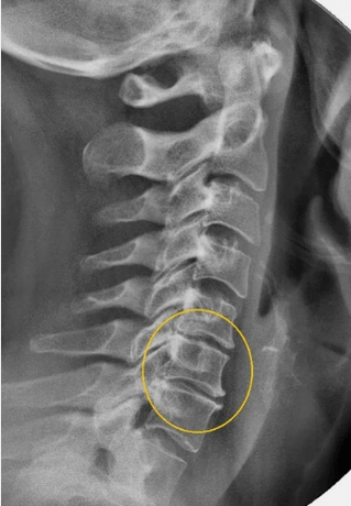 Osteochondrosis of cervical spine on x -ray