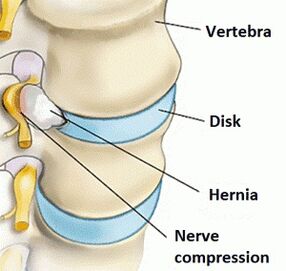 Osteochondrosis of cervical regions