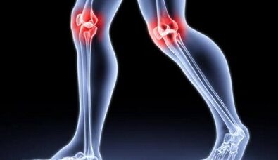 Prevention of arthritis and arthrosis development