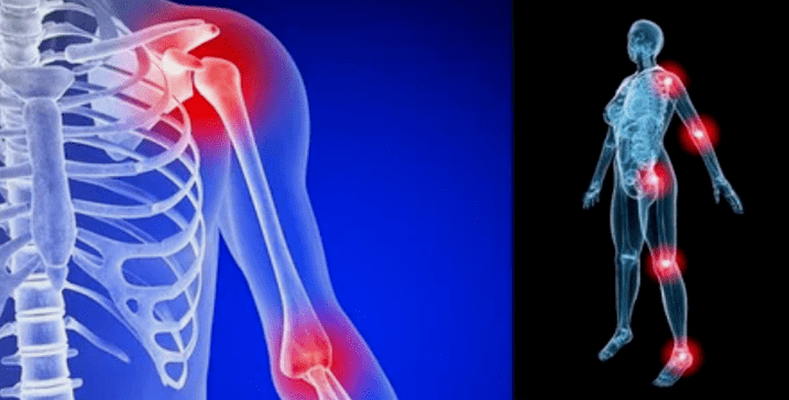 Deformation of arthrosis limbs