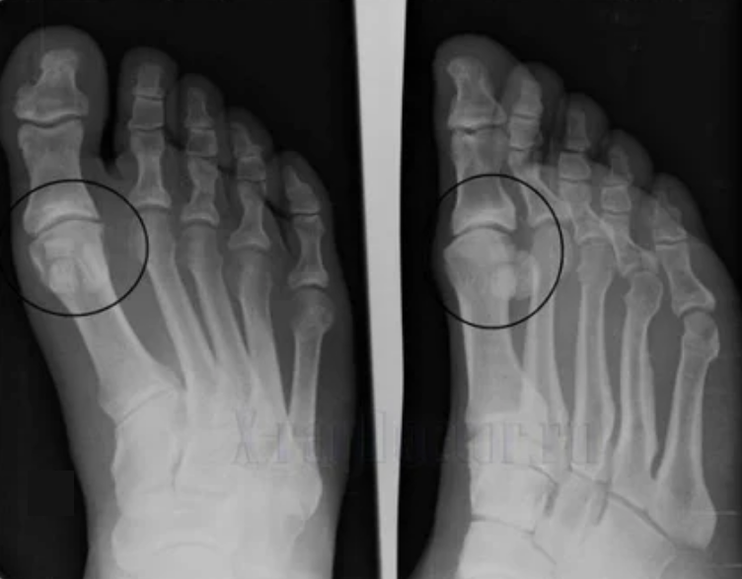 Diagnosis of arthrosis