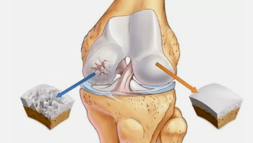 How arthrosis is developed