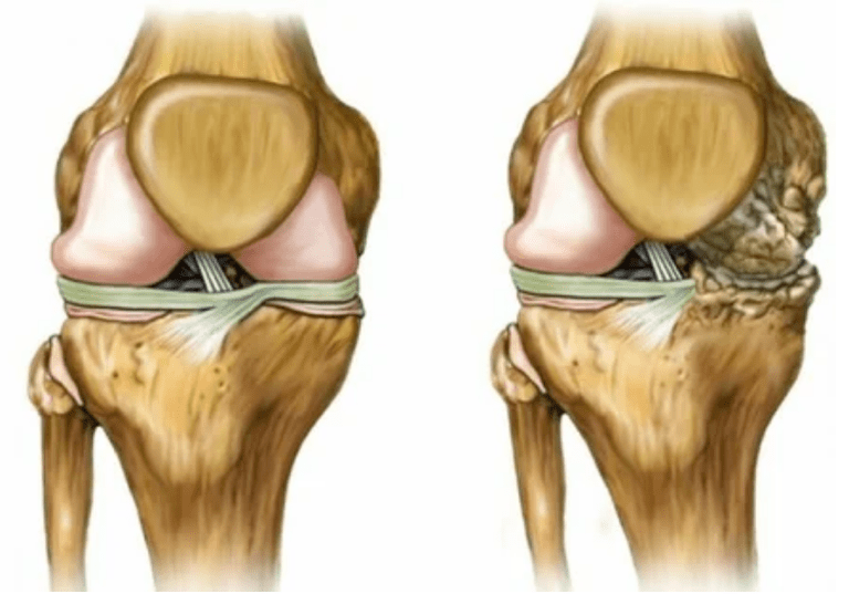 Phases of arthrosis