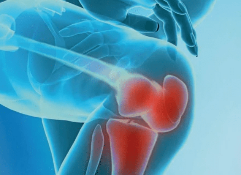 What is arthrosis