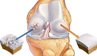 causes of joint arthrosis