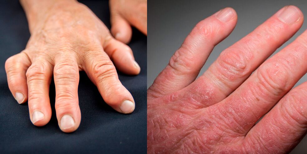 rheumatoid and psoriatic arthritis of the hand
