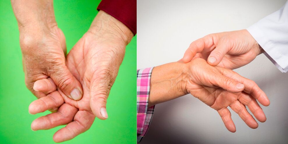 swelling and excruciating pain are the first signs of arthritis of the hands