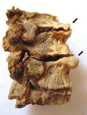 Section of the spine affected by osteochondrosis