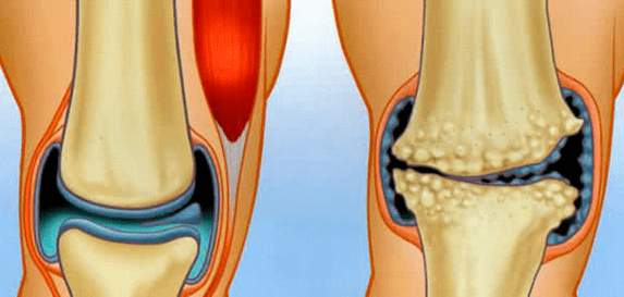Normal wrist and arthrosis