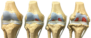 the degree of osteoarthritis