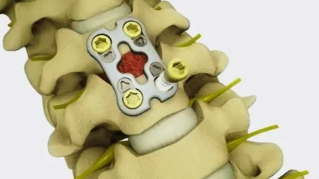 surgical treatment of degenerative disc disease